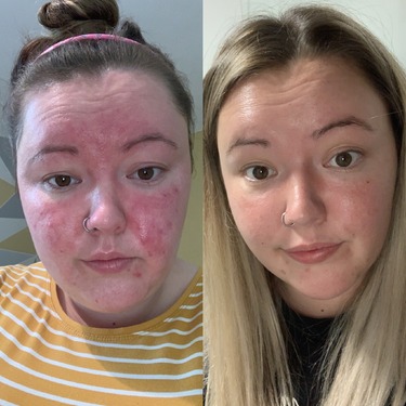 A Transformative Skin Journey: My Lumispa Review Before and After ...