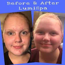 A Transformative Skin Journey: My Lumispa Review Before and After ...