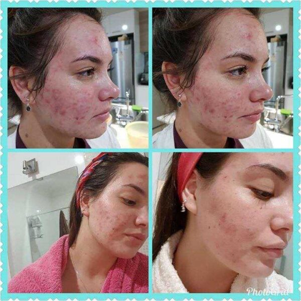 A Transformative Skin Journey: My Lumispa Review Before and After ...