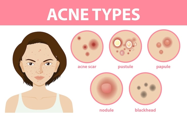 types-acne-skin