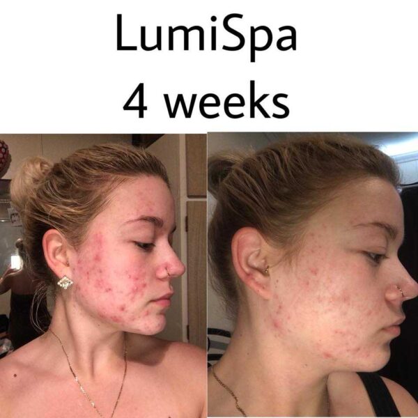 A Transformative Skin Journey My Lumispa Review Before and After