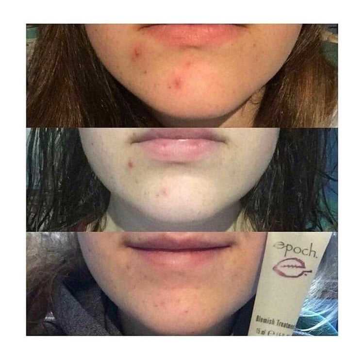 epoch-blemish-treatment-before-and-after