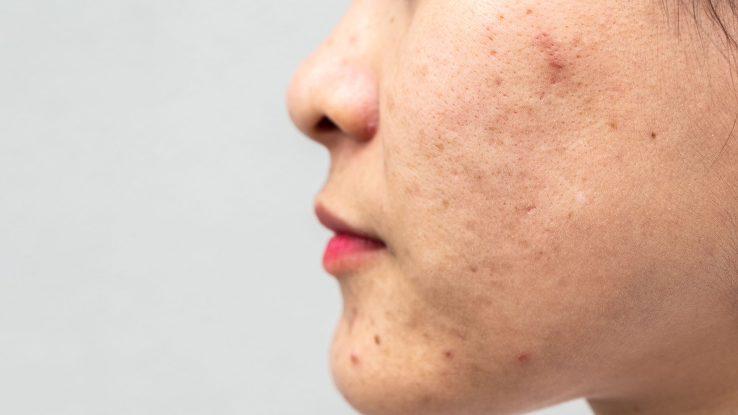 four-tips-for-clogged-pores