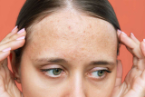 Unlocking Clear Skin: Defeating closed comedones forehead