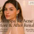 Does LumiSpa Help with Hormonal Acne? Scars, Reviews & More
