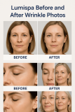 Lumispa Before and After Wrinkle Photos: Real Results You Need to See
