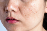 What You Need to Know About Skin Discoloration